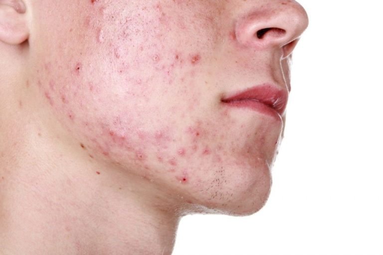 Read more about the article How To Remove Acne Marks