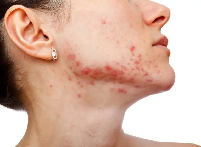 Read more about the article How To Remove Acne Spots