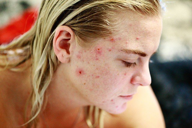 Read more about the article How To Remove Acne